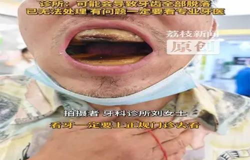 Demi Penghematan Pengeluaran, Pria Di China Ini Sampai Nekat Buat Gigi Palsu Bermodalkan Tutorial Dari Internet